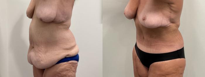 Before & After Breast Lift Case 486 Left Oblique View in Albany, Latham & Saratoga, New York