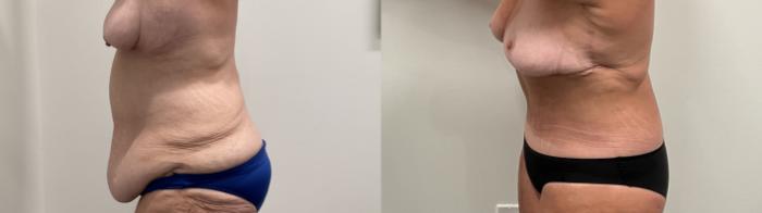 Before & After Breast Lift Case 486 Left Side View in Albany, Latham & Saratoga, New York