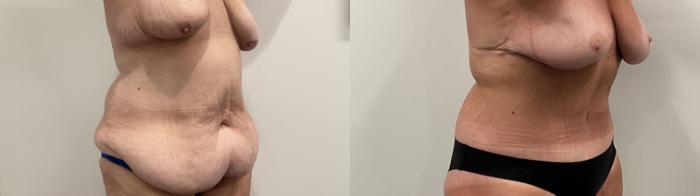Before & After Breast Lift Case 486 Right Oblique View in Albany, Latham & Saratoga, New York