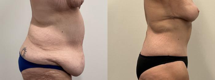 Before & After Breast Lift Case 486 Right Side View in Albany, Latham & Saratoga, New York