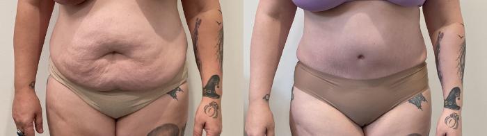 Before & After Tummy Tuck Case 487 Front View in Albany, Latham & Saratoga, New York