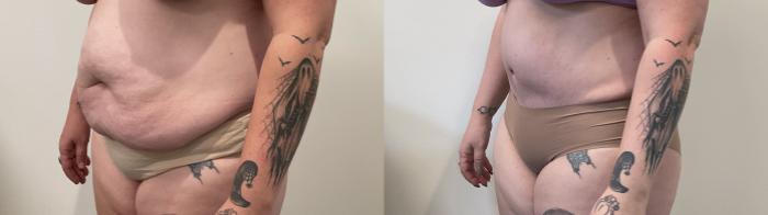 Before & After Tummy Tuck Case 487 Left Oblique View in Albany, Latham & Saratoga, New York