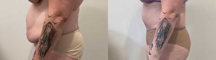 Before & After Tummy Tuck Case 487 Left Side View in Albany, Latham & Saratoga, New York