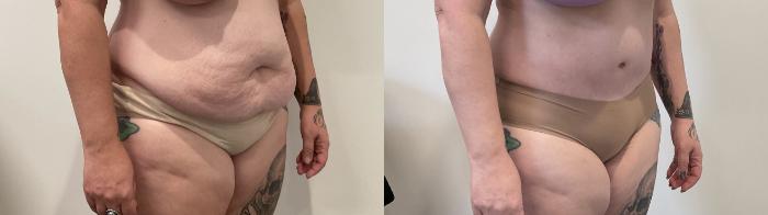 Before & After Tummy Tuck Case 487 Right Oblique View in Albany, Latham & Saratoga, New York