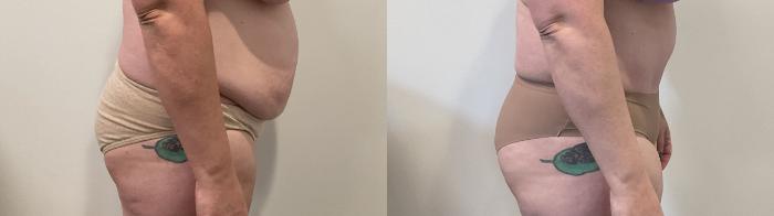 Before & After Tummy Tuck Case 487 Right Side View in Albany, Latham & Saratoga, New York