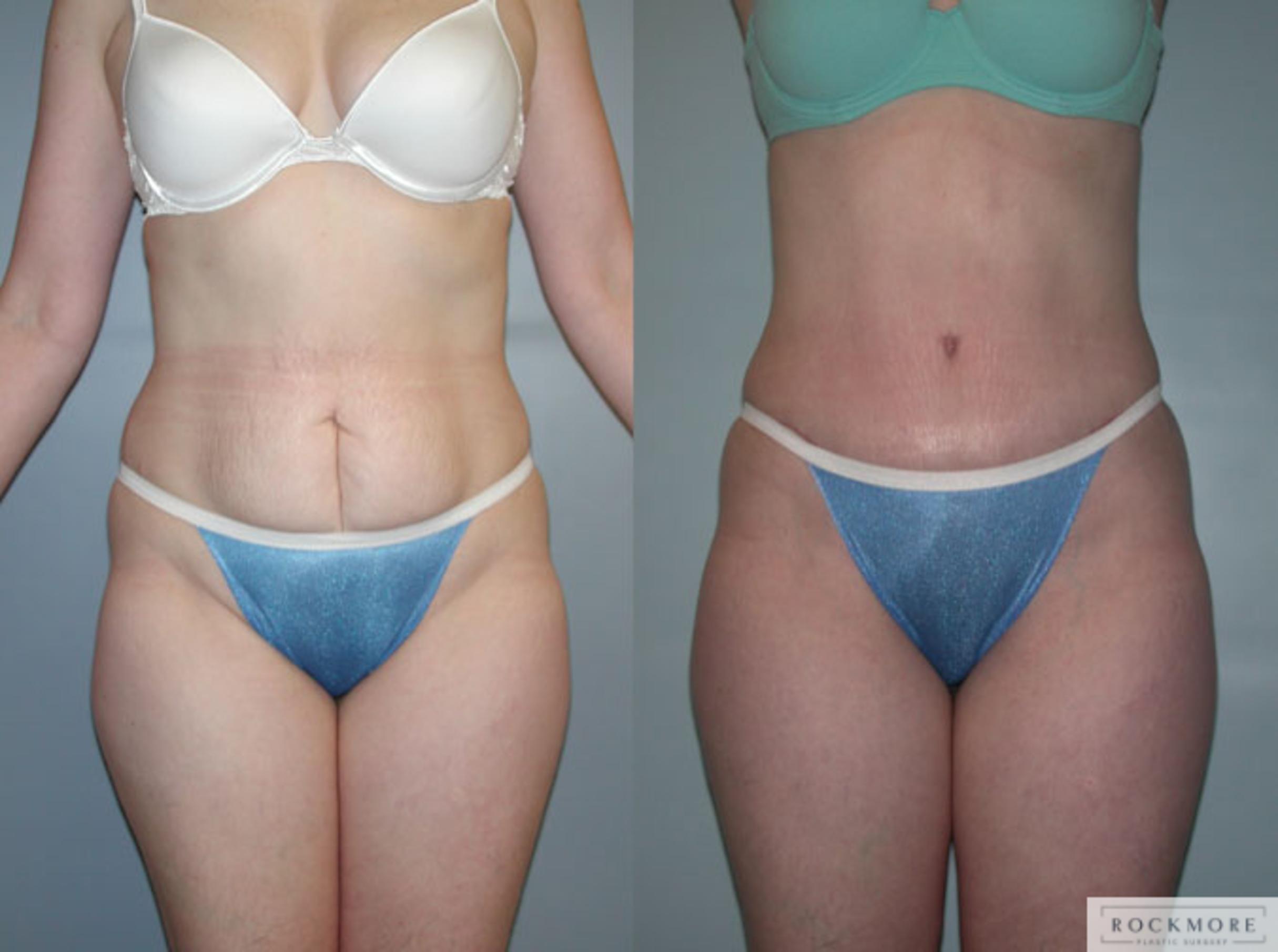 Before & After Tummy Tuck Case 49 View #1 View in Albany & Latham, New York