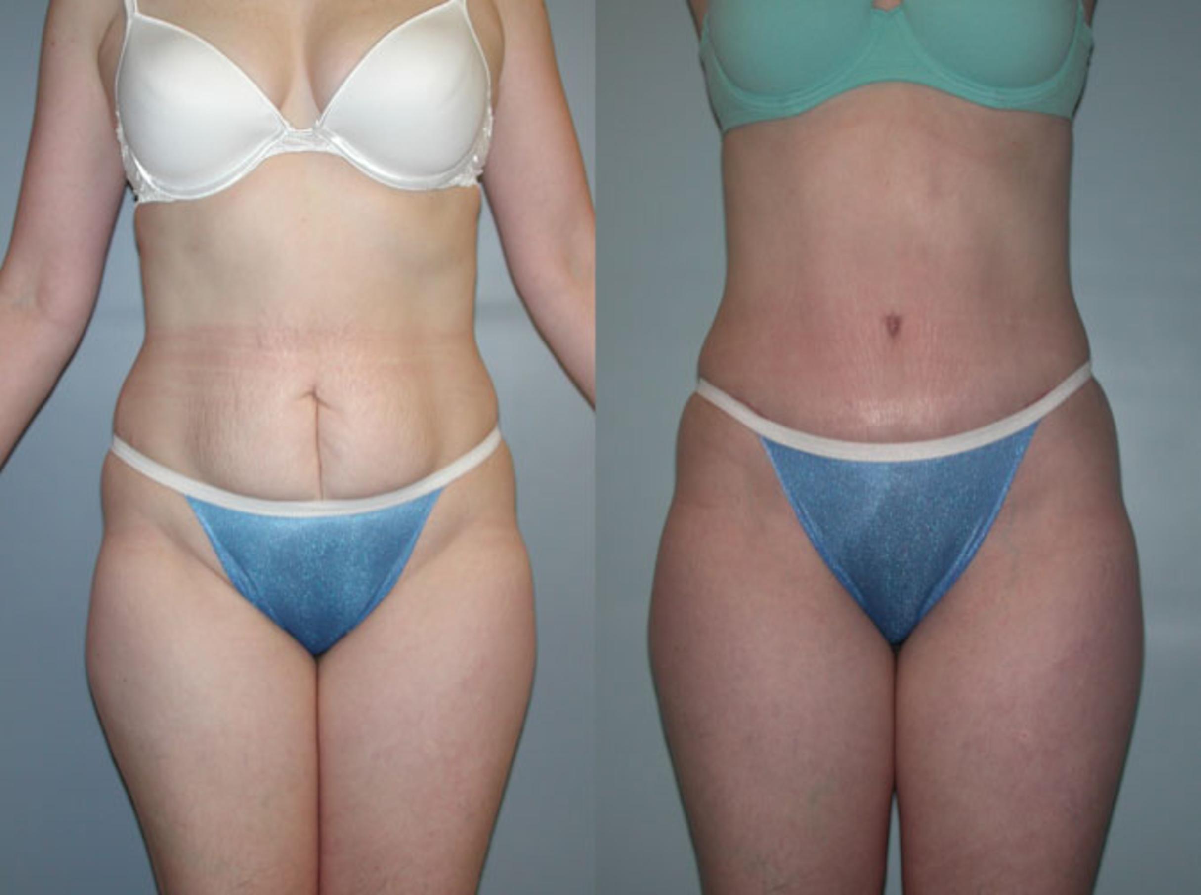 Tummy Tuck Before and After Pictures Case 49, Albany & Latham, New York