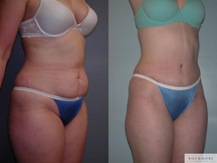 Before & After Tummy Tuck Case 49 View #2 View in Albany & Latham, New York