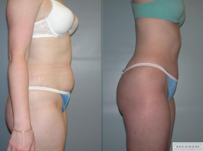 Before & After Tummy Tuck Case 49 View #3 View in Albany & Latham, New York