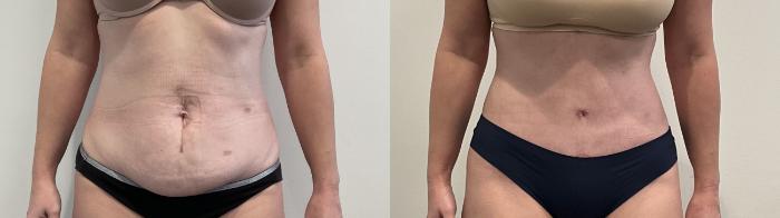 Before & After Tummy Tuck Case 494 Front View in Albany, Latham & Saratoga, New York