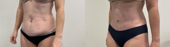 Before & After Tummy Tuck Case 494 Left Oblique View in Albany, Latham & Saratoga, New York