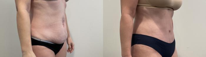 Before & After Tummy Tuck Case 494 Right Oblique View in Albany, Latham & Saratoga, New York