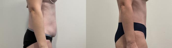 Before & After Tummy Tuck Case 494 Right Side View in Albany, Latham & Saratoga, New York