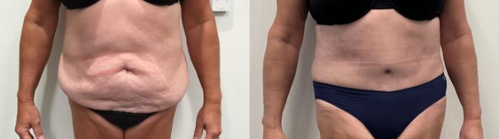 Before & After Tummy Tuck Case 495 Front View in Albany, Latham & Saratoga, New York