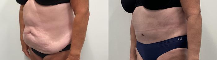 Before & After Tummy Tuck Case 495 Left Oblique View in Albany, Latham & Saratoga, New York