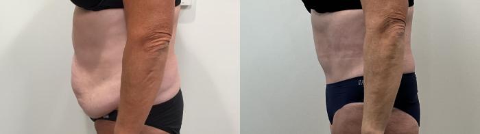 Before & After Tummy Tuck Case 495 Left Side View in Albany, Latham & Saratoga, New York