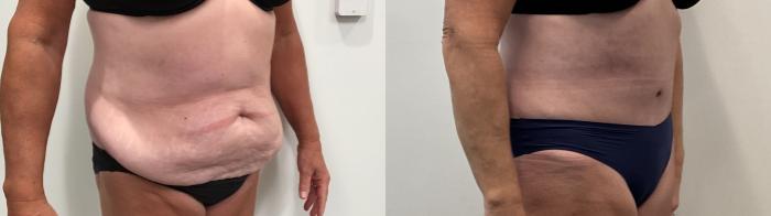 Before & After Tummy Tuck Case 495 Right Oblique View in Albany, Latham & Saratoga, New York