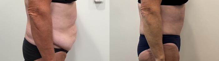 Before & After Tummy Tuck Case 495 Right Side View in Albany, Latham & Saratoga, New York