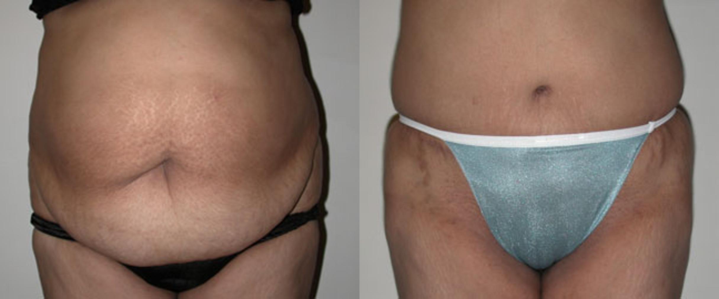 Before & After Tummy Tuck Case 50 View #1 View in Albany & Latham, New York