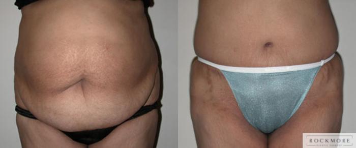 Before & After Tummy Tuck Case 50 View #1 View in Albany & Latham, New York