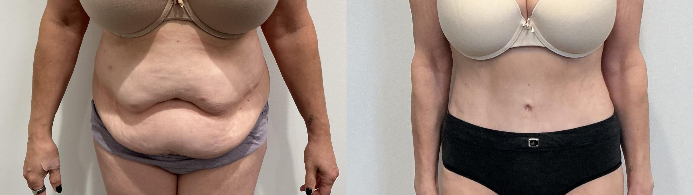 Before & After Tummy Tuck Case 501 Front View in Albany, Latham & Saratoga, New York