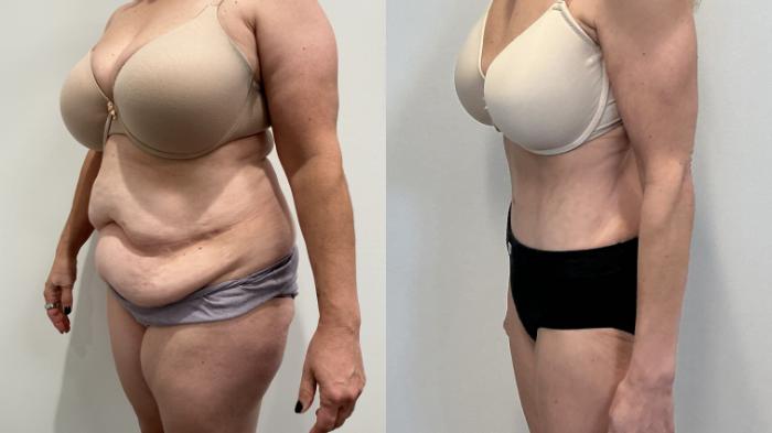 Before & After Tummy Tuck Case 501 Left Oblique View in Albany, Latham & Saratoga, New York
