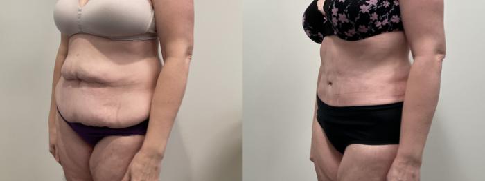 Before & After Tummy Tuck Case 513 Left Oblique View in Albany, Latham & Saratoga, New York