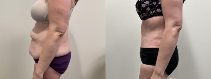 Before & After Tummy Tuck Case 513 Left Side View in Albany, Latham & Saratoga, New York