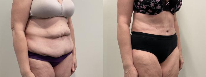 Before & After Tummy Tuck Case 513 Right Oblique View in Albany, Latham & Saratoga, New York