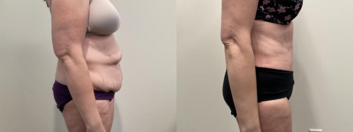 Before & After Tummy Tuck Case 513 Right Side View in Albany, Latham & Saratoga, New York