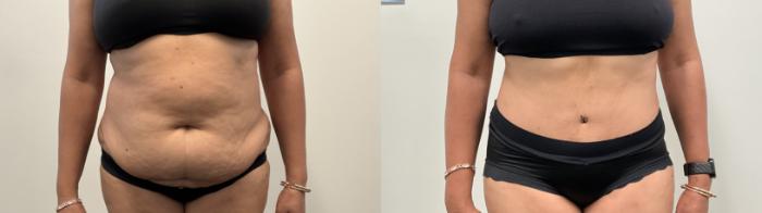 Before & After Tummy Tuck Case 515 Front View in Albany, Latham & Saratoga, New York