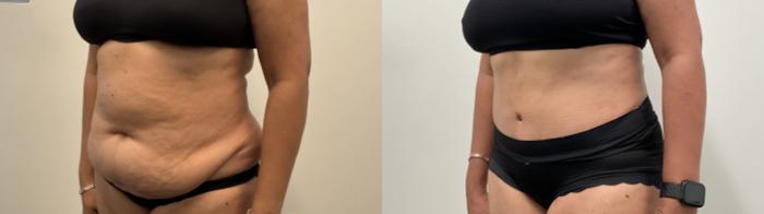 Before & After Tummy Tuck Case 515 Left Oblique View in Albany, Latham & Saratoga, New York