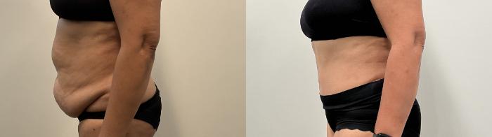 Before & After Tummy Tuck Case 515 Left Side View in Albany, Latham & Saratoga, New York