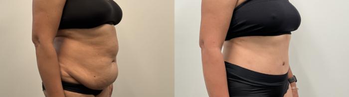 Before & After Tummy Tuck Case 515 Right Oblique View in Albany, Latham & Saratoga, New York
