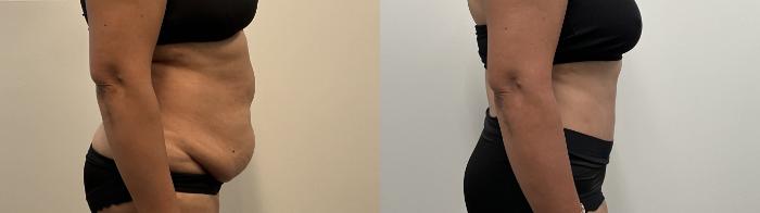 Before & After Tummy Tuck Case 515 Right Side View in Albany, Latham & Saratoga, New York