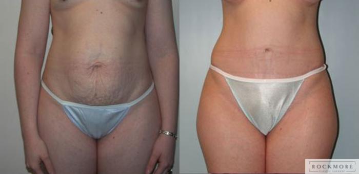 Before & After Tummy Tuck Case 65 View #1 View in Albany & Latham, New York