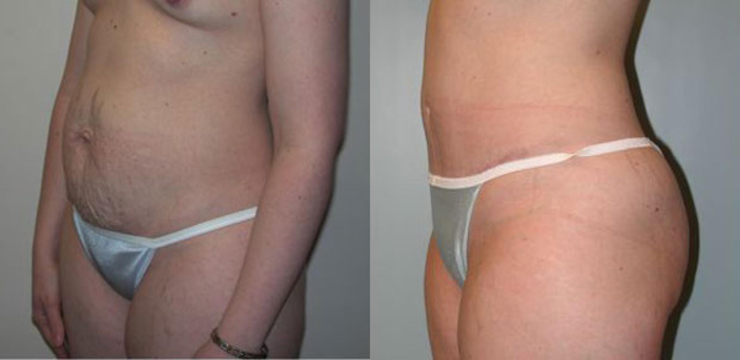 Before & After Tummy Tuck Case 65 View #2 View in Albany, Latham & Saratoga, New York