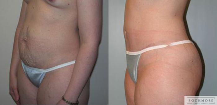 Before & After Tummy Tuck Case 65 View #2 View in Albany & Latham, New York