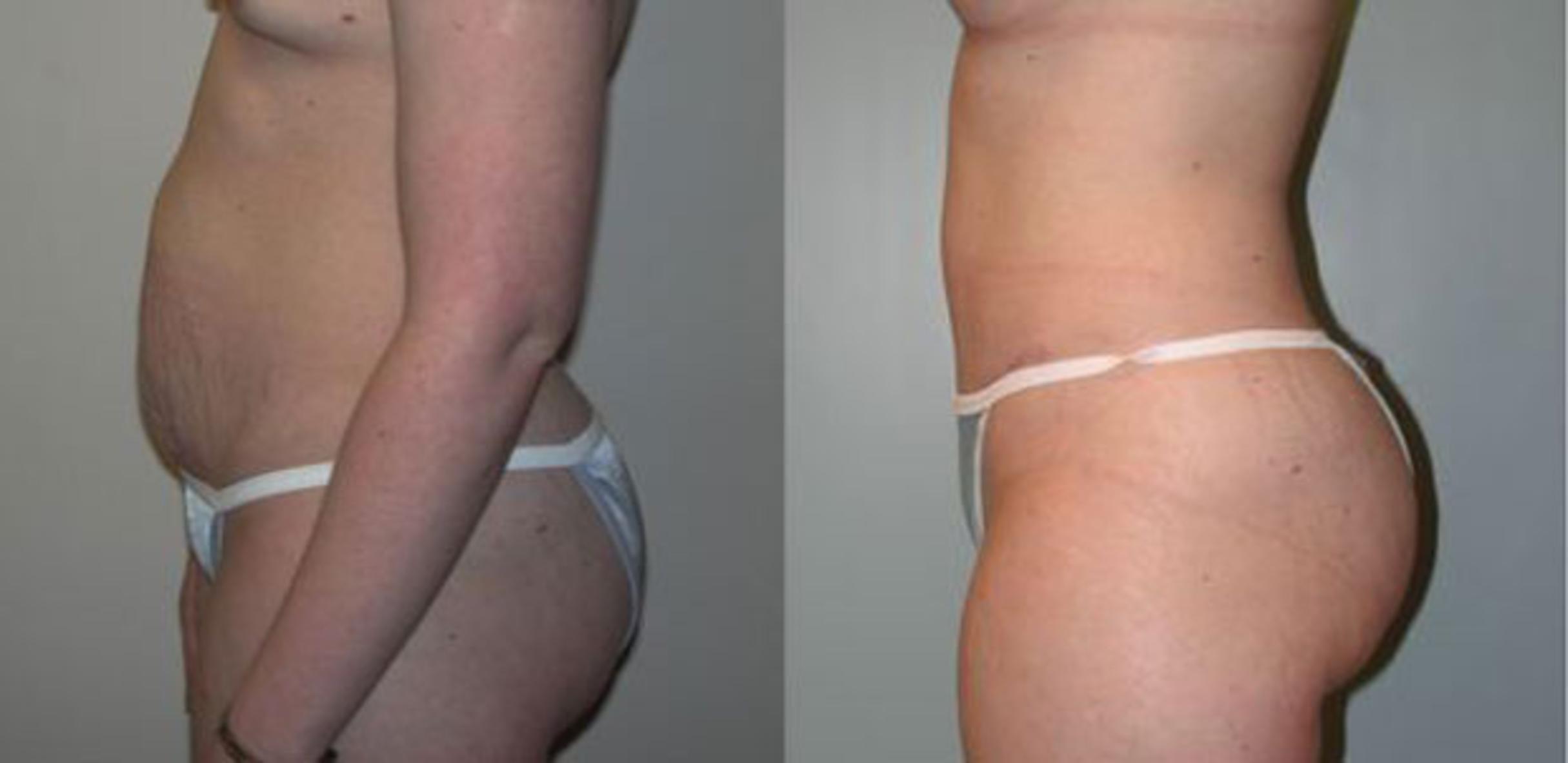 Before & After Tummy Tuck Case 65 View #3 View in Albany, Latham & Saratoga, New York