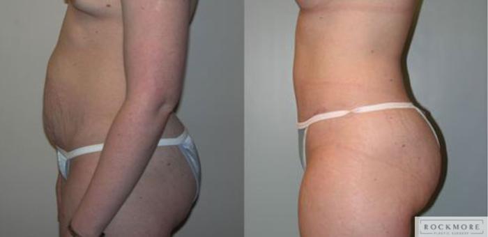 Before & After Tummy Tuck Case 65 View #3 View in Albany & Latham, New York